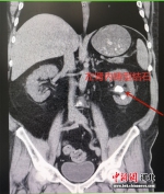患者左肾内铸型结石。 市二医院供图 - 中国新闻社河北分社